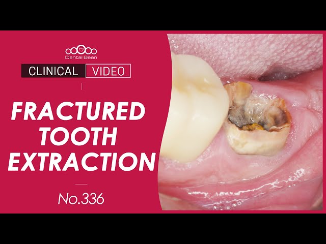 #37 Immediate implant placement after extraction [Dr. Cho Yongseok]