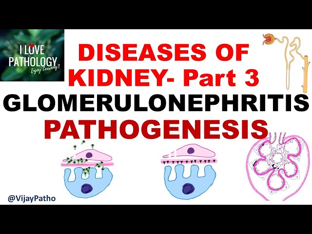 RENAL PATHOLOGY Part 3 : Glomerulonephritis- PATHOGENESIS