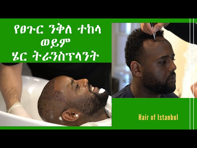 የዚህ ኢትዮጵያዊ ወንድማችንን የፀጉር ንቅለ ተከላ ህክምና ይመልከቱ ፤ ዮኒ ማኛ Yoni Magna, we gotcha bro!