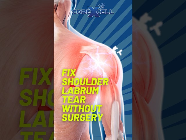 Fix Shoulder Labrum Tear Without Surgery