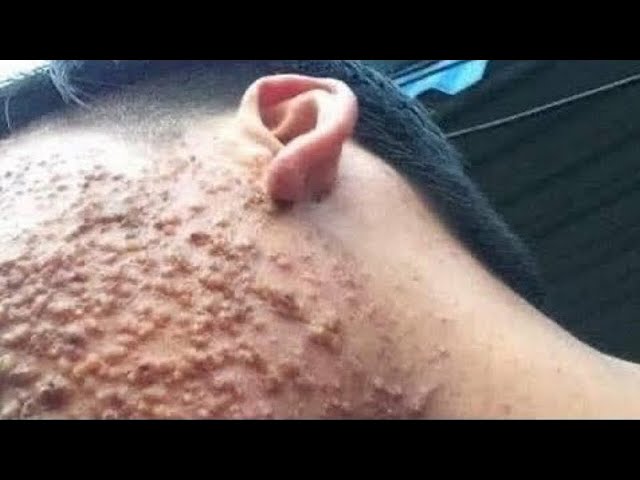 Big Cystic Acne Blackheads Extraction Blackheads & Milia, Whiteheads Removal Pimple Popping