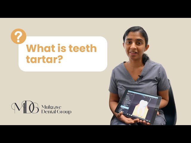 Ask the Dentist: Teeth Tartar Explained with Dr. Diluni | Mulgrave Dental Group