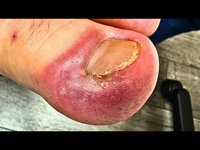 DEEEEEP Extreme Ingrown Nail Removal On Muay Thai Boxer!