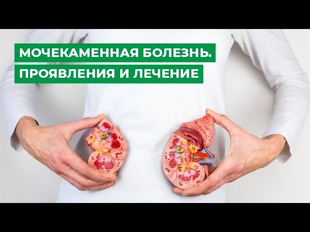 Мочекаменная болезнь. Проявления и лечение.