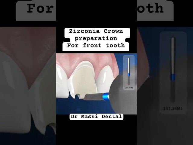 Zirconia Crown preparation