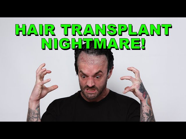 What They're Not Telling You About Hair Transplantation