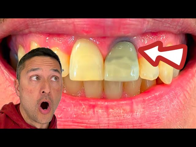 How to Internal BLEACH a root canaled tooth.