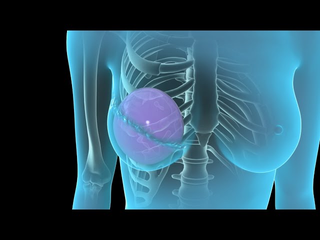 Breast Cancer | Breast Reconstruction | Nucleus Health