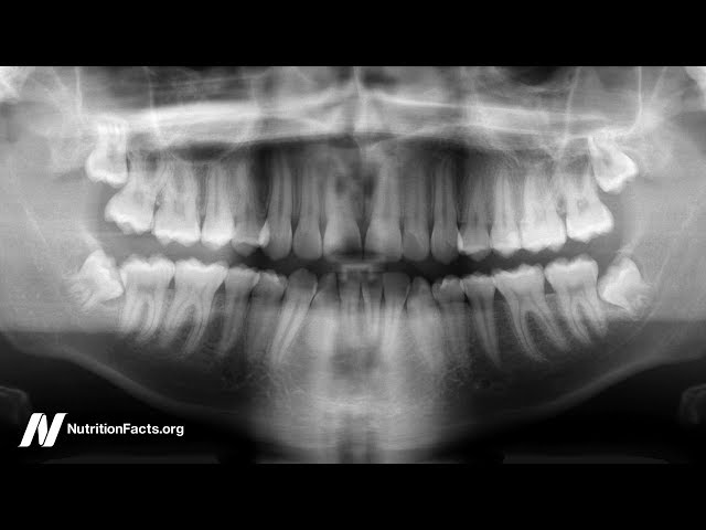 How to Treat Periodontitis with Diet