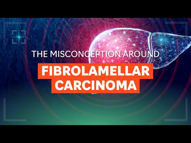 The misconception around fibrolamellar carcinoma