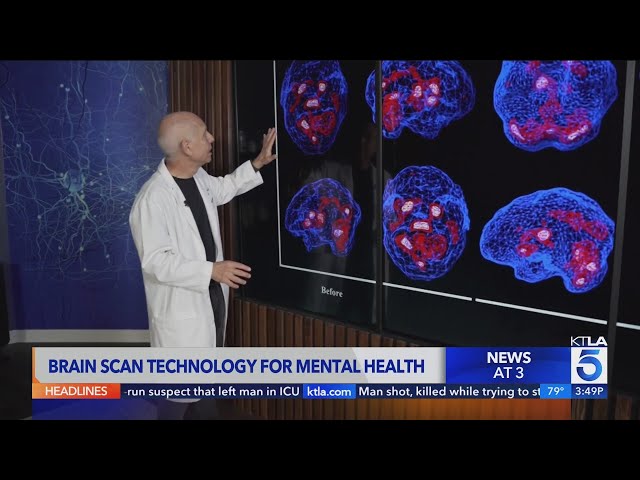 Brain scan helps address mental health issues L.A. firefighters, first responders face