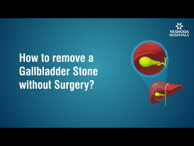 How to remove Gallbladder Stone without surgery?