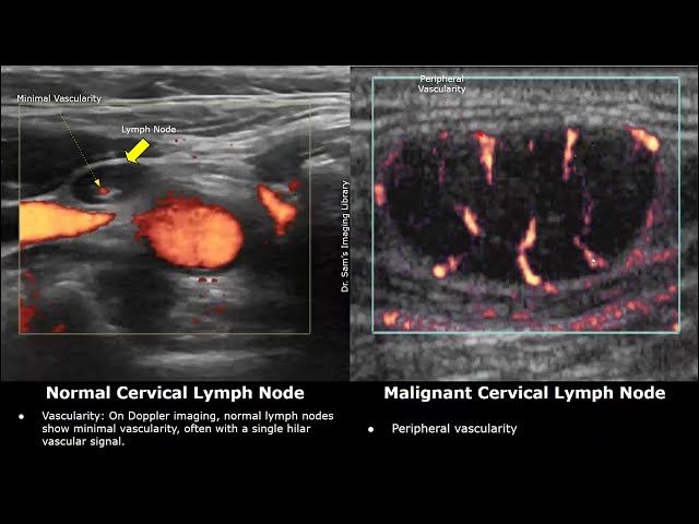 Cervical Lymph Nodes Ultrasound Normal Vs Abnormal Images | Reactive & Malignant Neck Nodes USG Scan