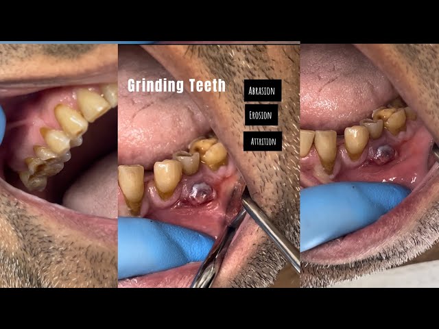 GRINDING TEETH , Abrasion,Erosion ,Attrition