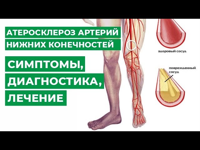 Атеросклероз артерий нижних конечностей, симптомы, диагностика, лечение.