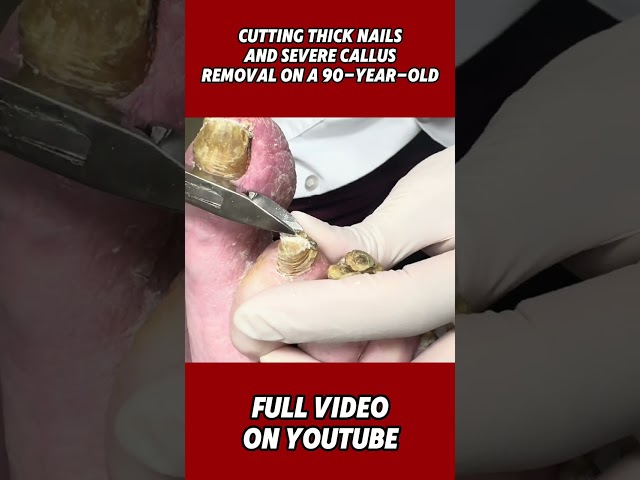 Cutting Thick Nails and Severe Callus Removal on a 90-Year-Old | Expert Foot Care Transformation