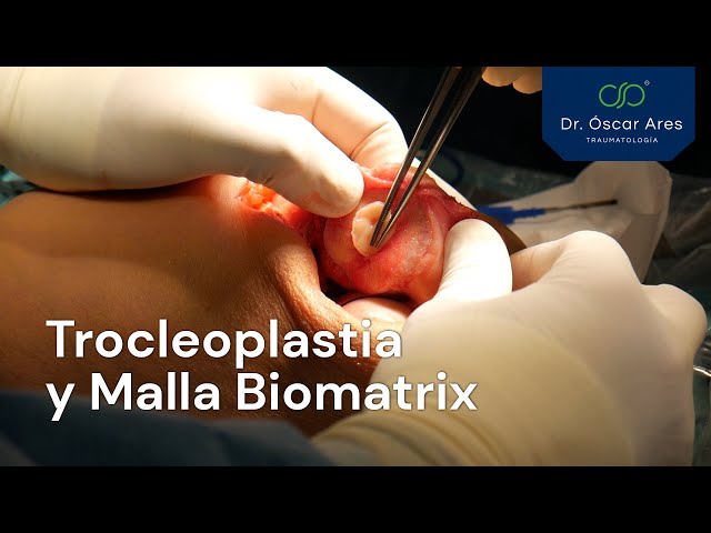 Trocleoplastia y Malla Biomatrix - Dr. Oscar Ares