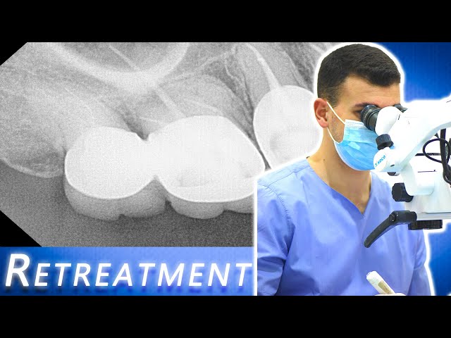 Upper first molar retreatment - removing gutta percha and Building up with Fiber post