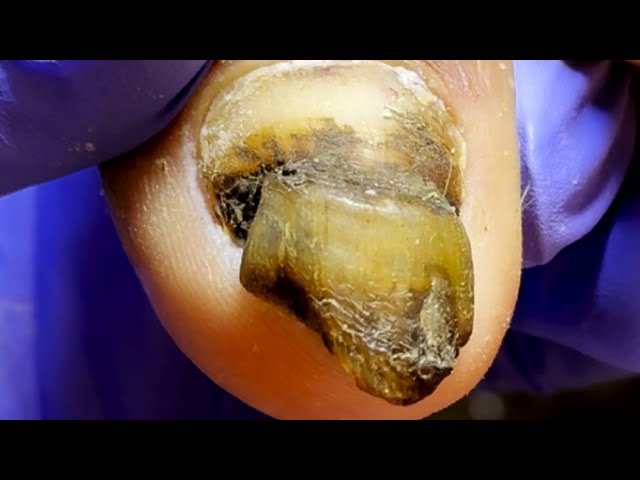 Oh My God! Dirty And Thick Onychomycosis [Doctor Liu Pedicure]