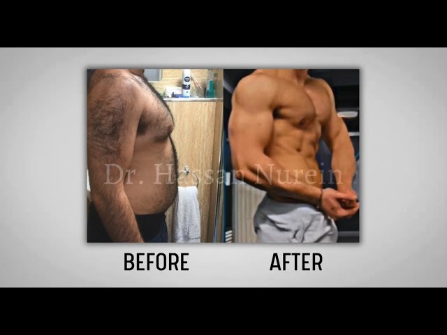 Before and After Gynecomastia Surgery Body Transformations with Dr Hassan Nurein, Harley St London