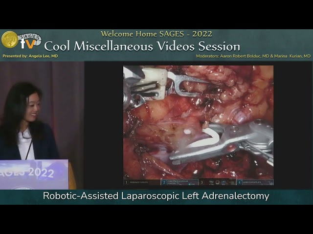 Robotic-Assisted Laparoscopic Left Adrenalectomy