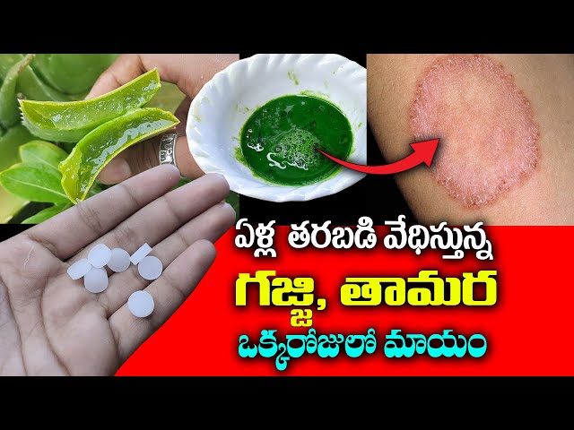 ఒక్క రోజులో తామర మటుమాయం || How to Remove Ringworm Naturally #kskhome