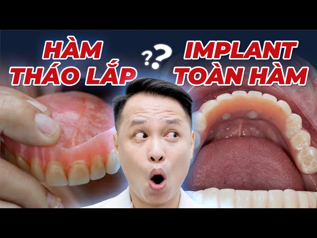 Giải Pháp Cho Người Mất Hết Răng: Hàm Giả Tháo Lắp Hay Trồng Răng Implant? Cái Tốt Nhất?