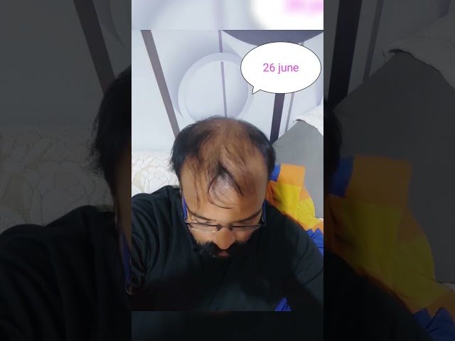 hair regrowth 4 months result without hair transplant