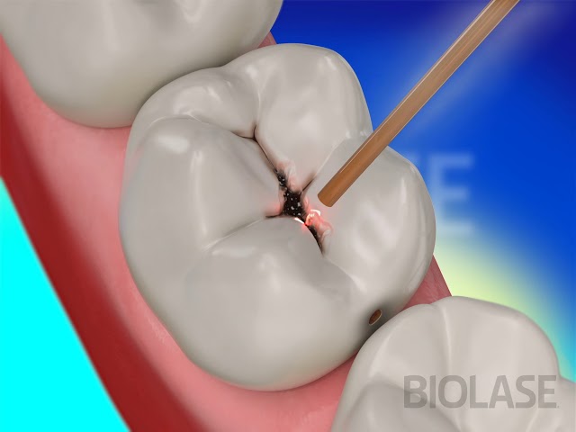 Dental Restoration with Waterlase Laser Dentistry - BIOLASE