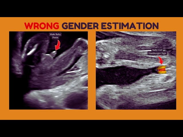 Fetal Gender Ultrasound was WRONG!🤔🥺 Why there Can be Mistakes in Checking Baby Boy or Girl Gender