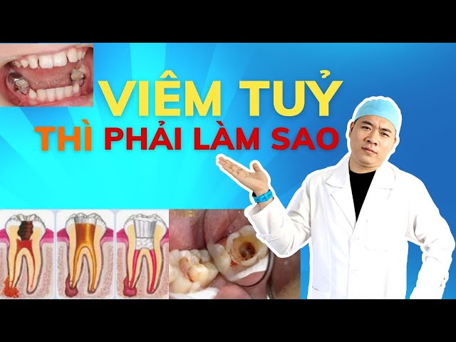 Răng Hàm Mặt - Điều Trị Viêm Tủy Răng Thế Nào ? | Nha Khoa Smile HT