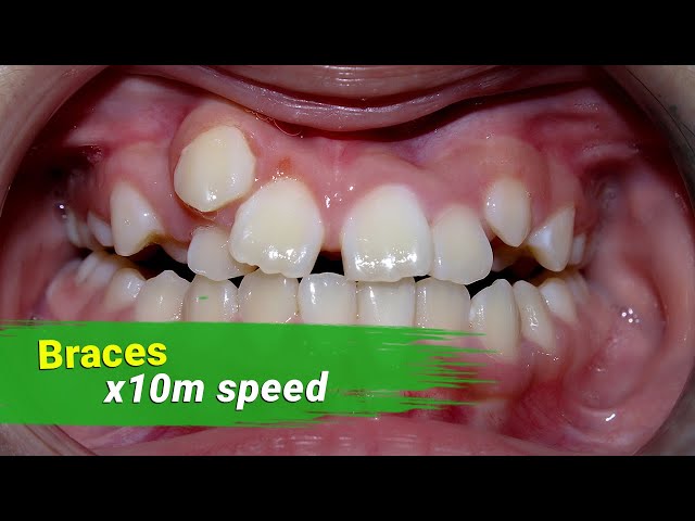 Braces 3 year - x10 milion speed