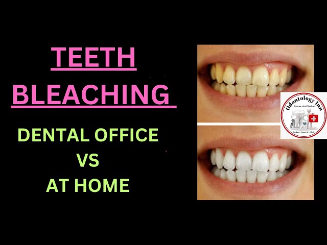 TEETH WHITENING AT DENTAL OFFICE VS AT HOME TEETH WHITENING |  VITAL TEETH WHITENING