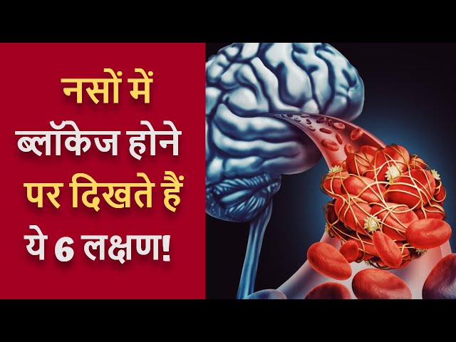 नसों में ब्लॉकेज के लक्षण | Naso me blockage ke lakshan | Heart ki Nas Block Hone ke Lakshan