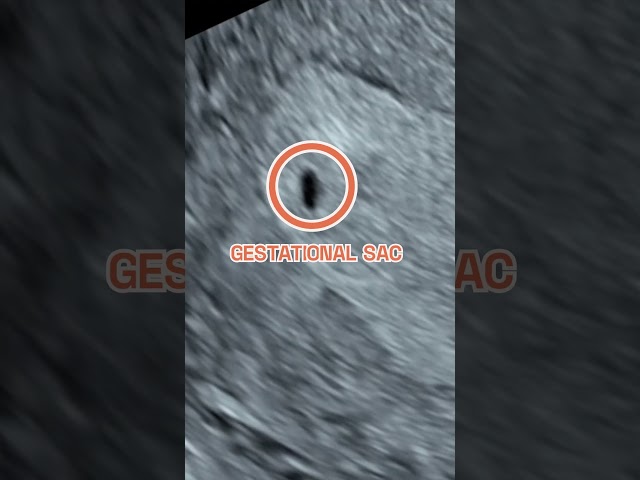 Your baby at 4 weeks pregnant - Early Ultrasound Scan