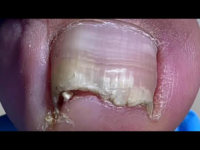 Deep ingrown nails, many small nail fragments【Pedicure Master Lin Jun】