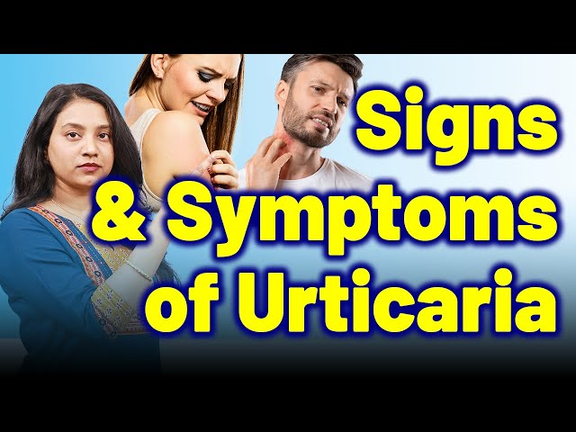 Symptoms and Signs of Urticaria, Nettle rash, Hives, Wheals. | Treatment Cure | SkinAllergy