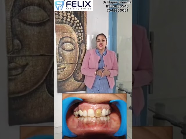 Broken front teeth|| Never ignore||For more information contact: Felix multispeciality denta clinic