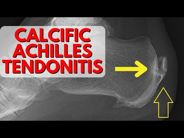 Calcific Achilles Tendinitis Treatment & Causes