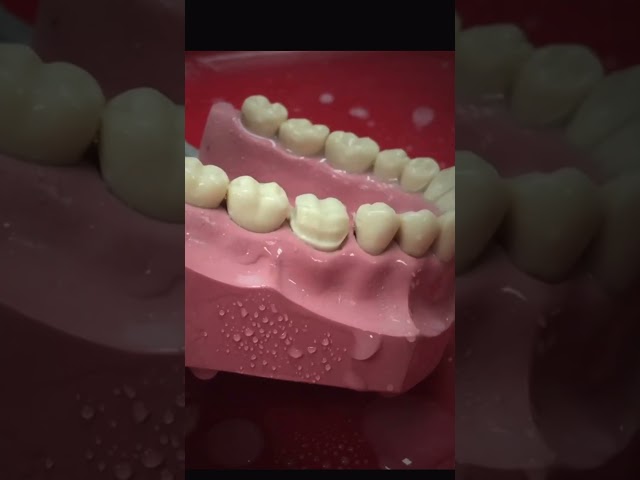 Dental crown preparation- part 2 (proximal surface reduction) #teeth #teethstreet #dental #dentaltip