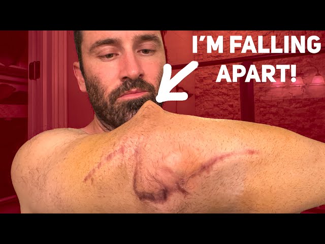 The Surgery to Save My Arm (My Toughest Recovery Yet)