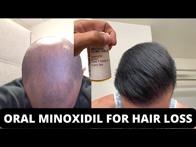 I'm On 2.5 Mg Oral Minoxidil For Hair Loss #shorts