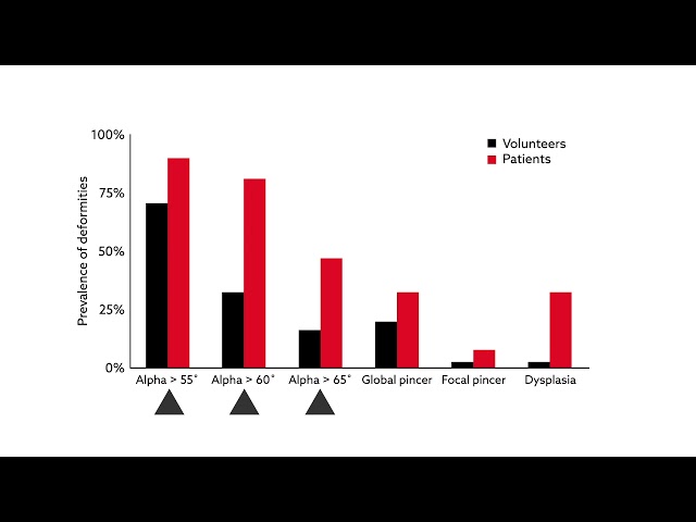 Using MRI to identify the anatomic predictors of hip impingement