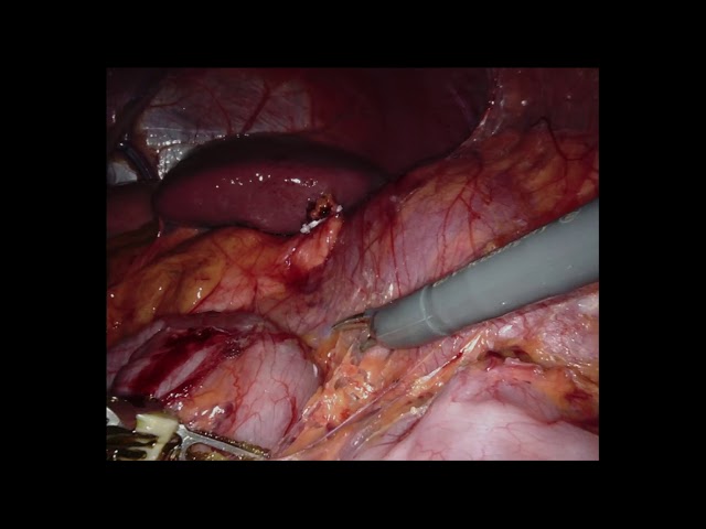 Robotic Left Adrenalectomy for Pheochromocytoma using the Xi Robot