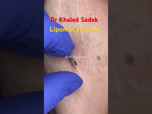 Massive blackhead extraction Dr Khaled Sadek #blackheadremoval #blackheads #skincare