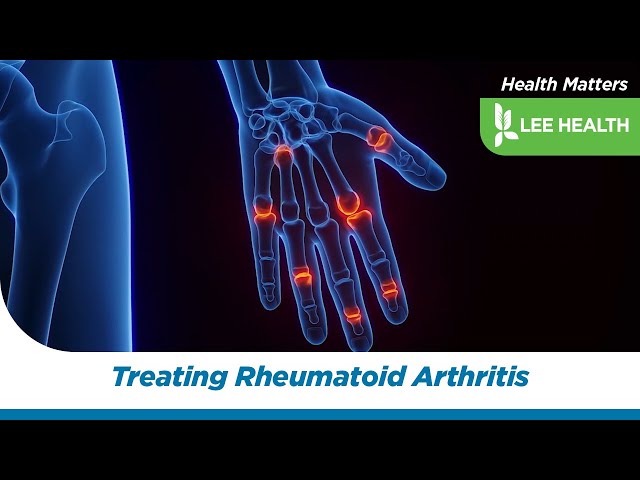 Treating Rheumatoid Arthritis