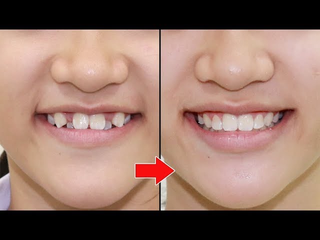 Niềng răng thay đổi nụ cười như thế nào? (Braces change smiles)