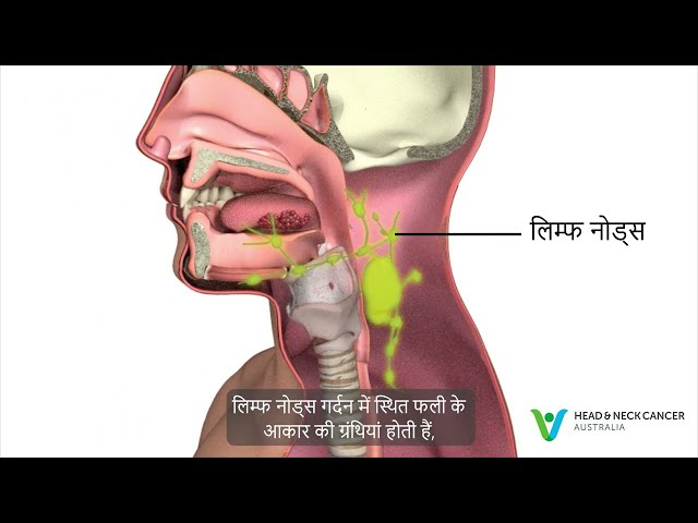 Hindi - What is Oral or Mouth Cancer? Signs & Symptoms. Head and Neck Cancer