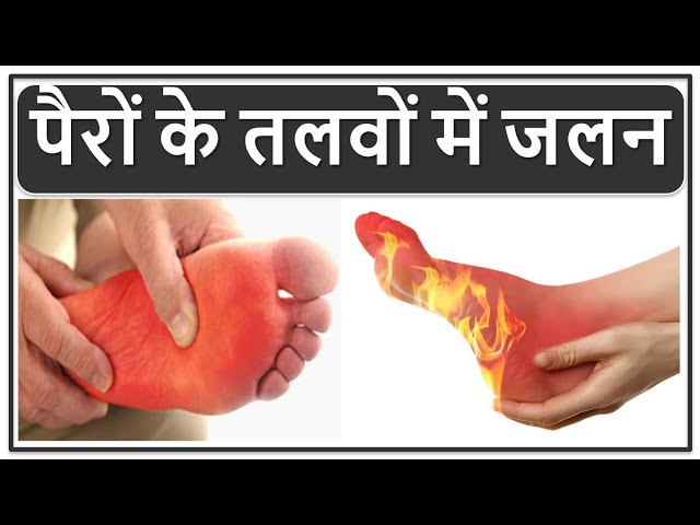 पैरों के तलवों में जलन का इलाज, पैरों में जलन होने से कौन सी बीमारी होती है?, Burning Feet Treatment