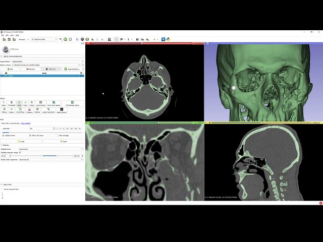 Part 1 - Using 3D Slicer to create a human skull and orbit model from a CT scan - SIMPLE METHOD